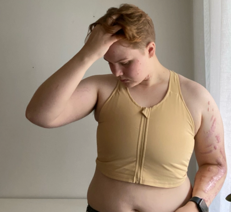 Burn your Binders, Girls! Self-harm is evident on the arm of this girl who is wearing a binder. She looks sad.