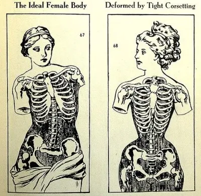 Burn your binders, Girls! Victorian anatomical drawing of a The Ideal Female body deformed by tight corseting binders are the new corset